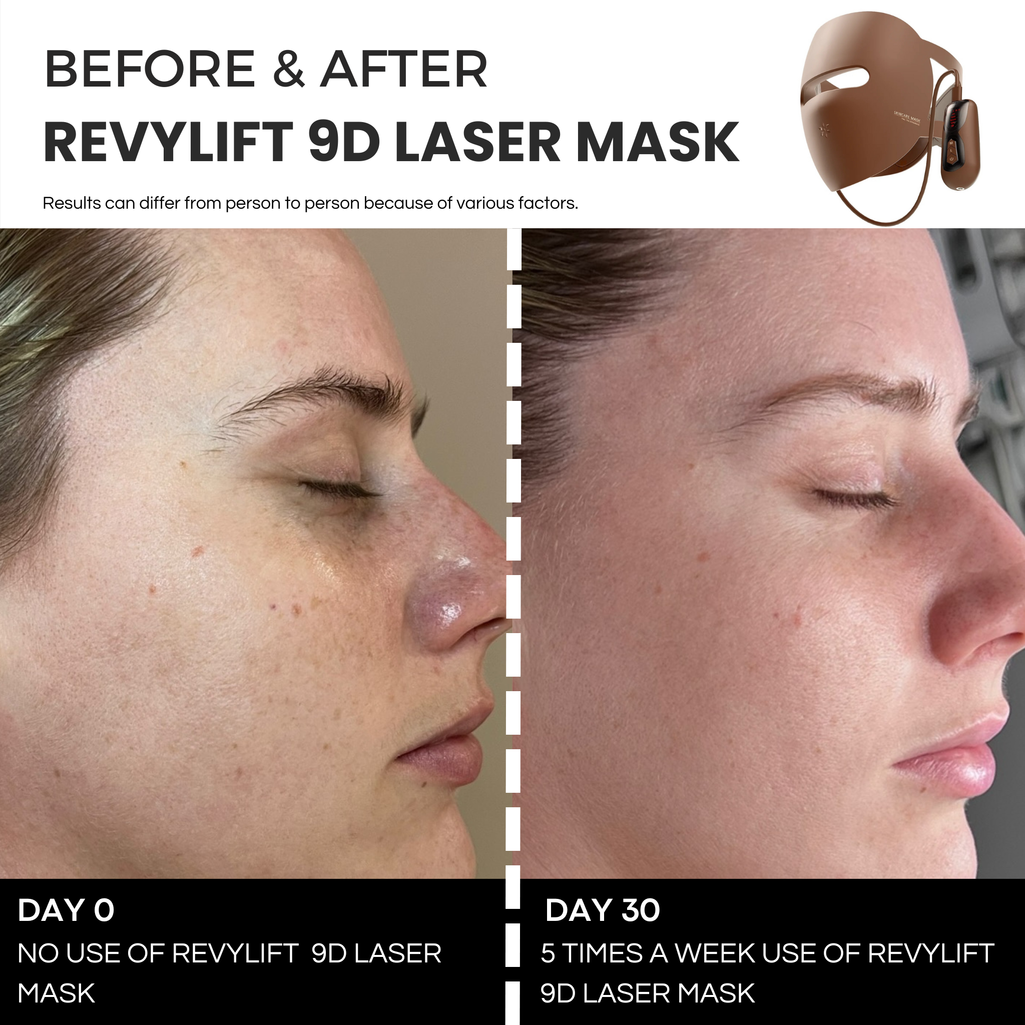 REVYLIFT™ 9D PRECISION LASER MASK
