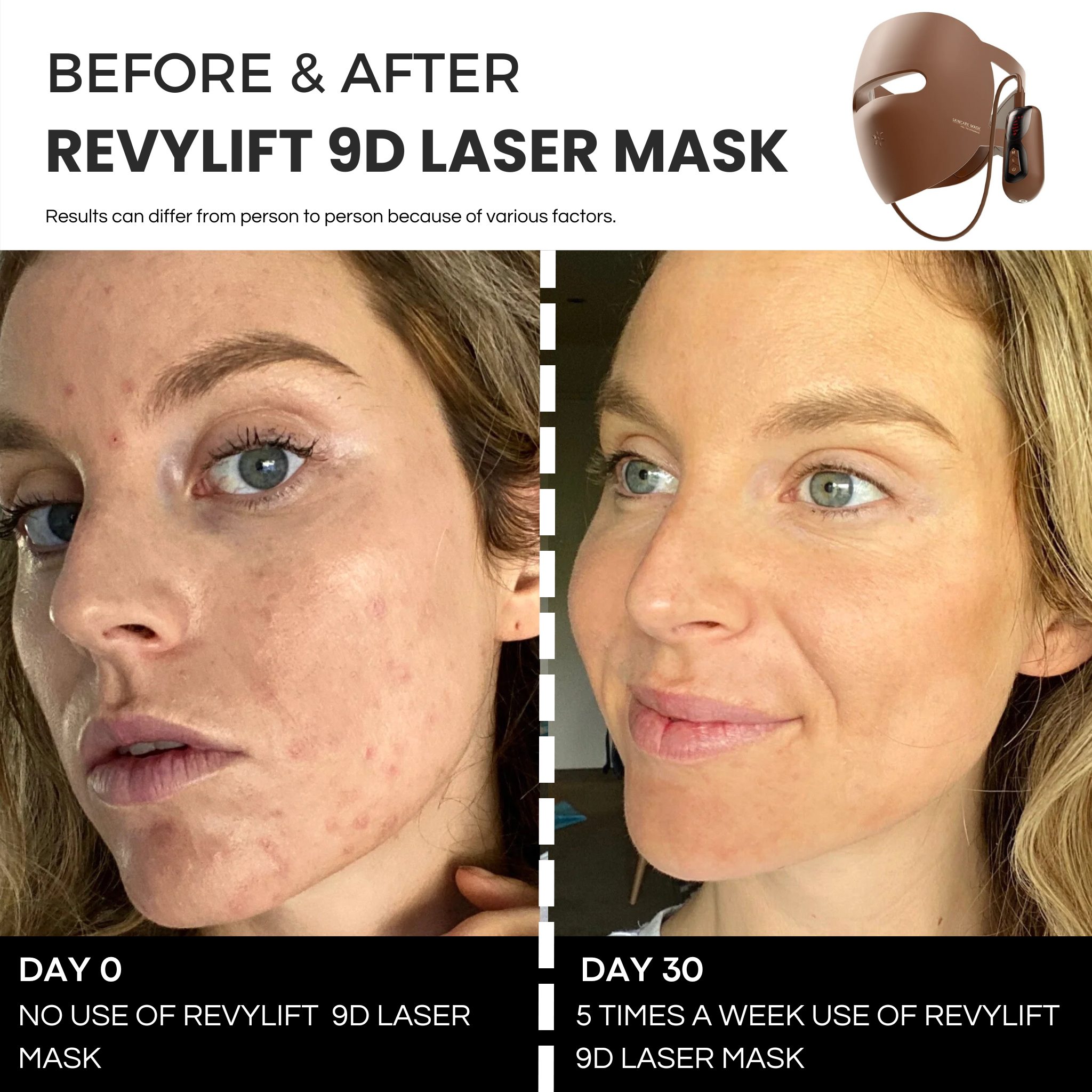 REVYLIFT™ 9D PRECISION LASER MASK