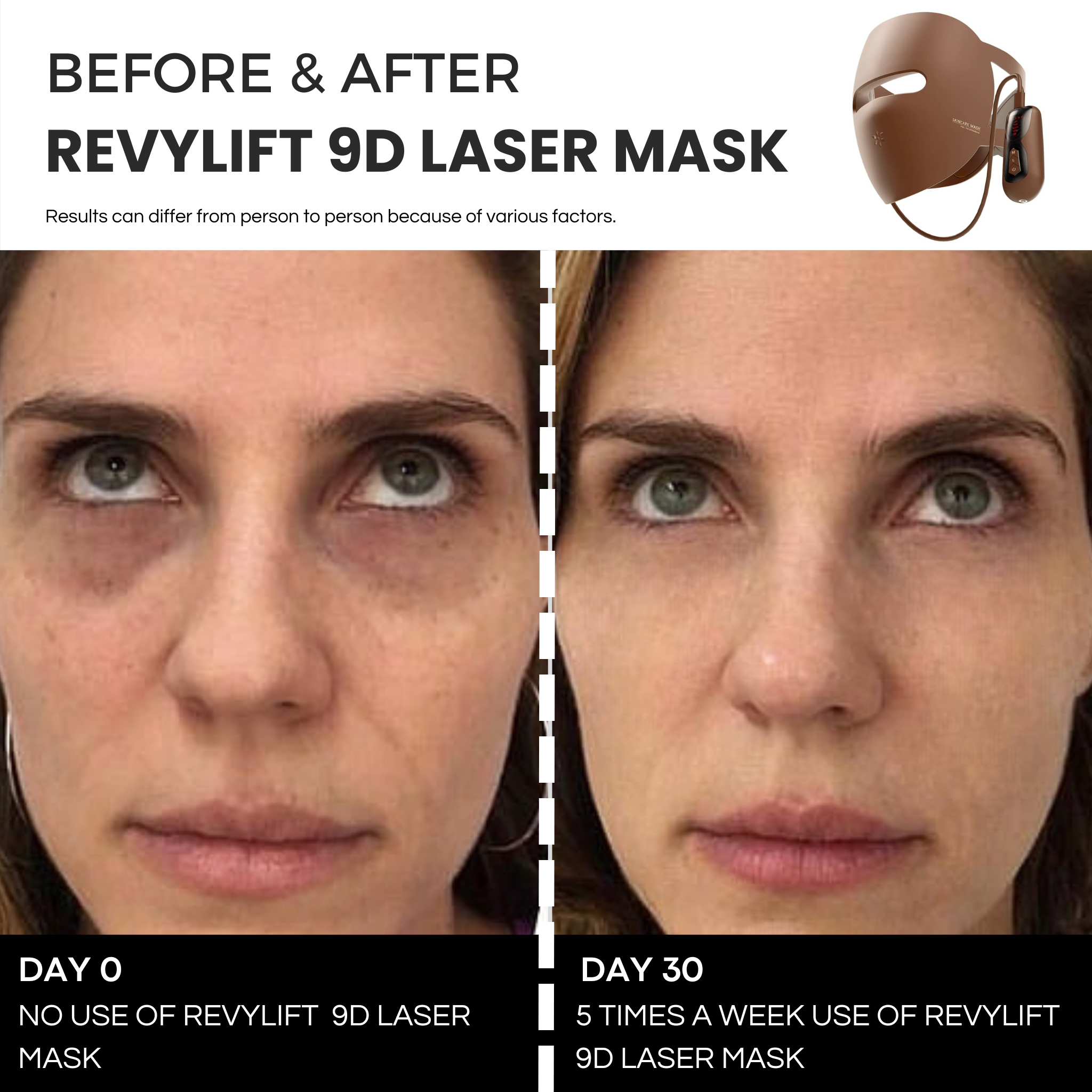 REVYLIFT™ 9D PRECISION LASER MASK