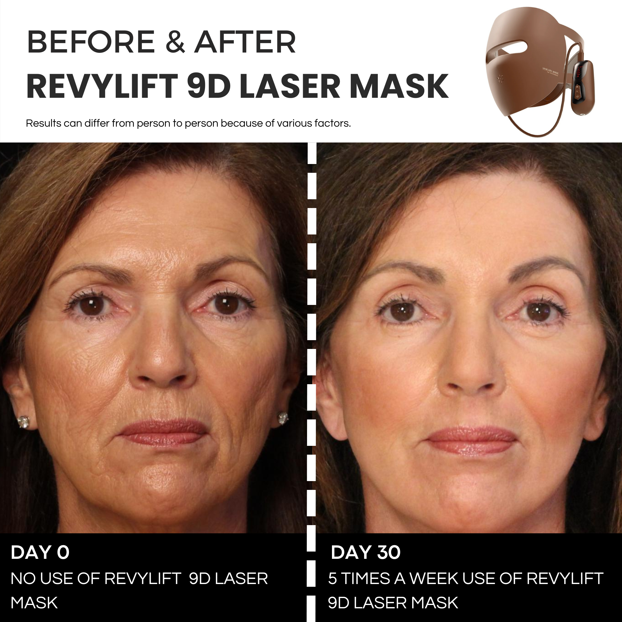 REVYLIFT™ 9D PRECISION LASER MASK