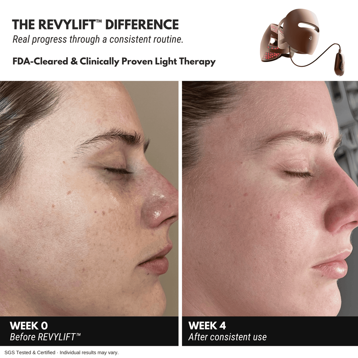 REVYLIFT™ 9D Precision Laser Mask - REVYLIFT