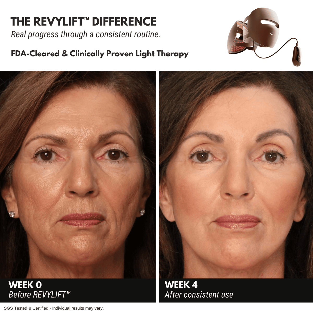 REVYLIFT™ 9D Precision Laser Mask - REVYLIFT