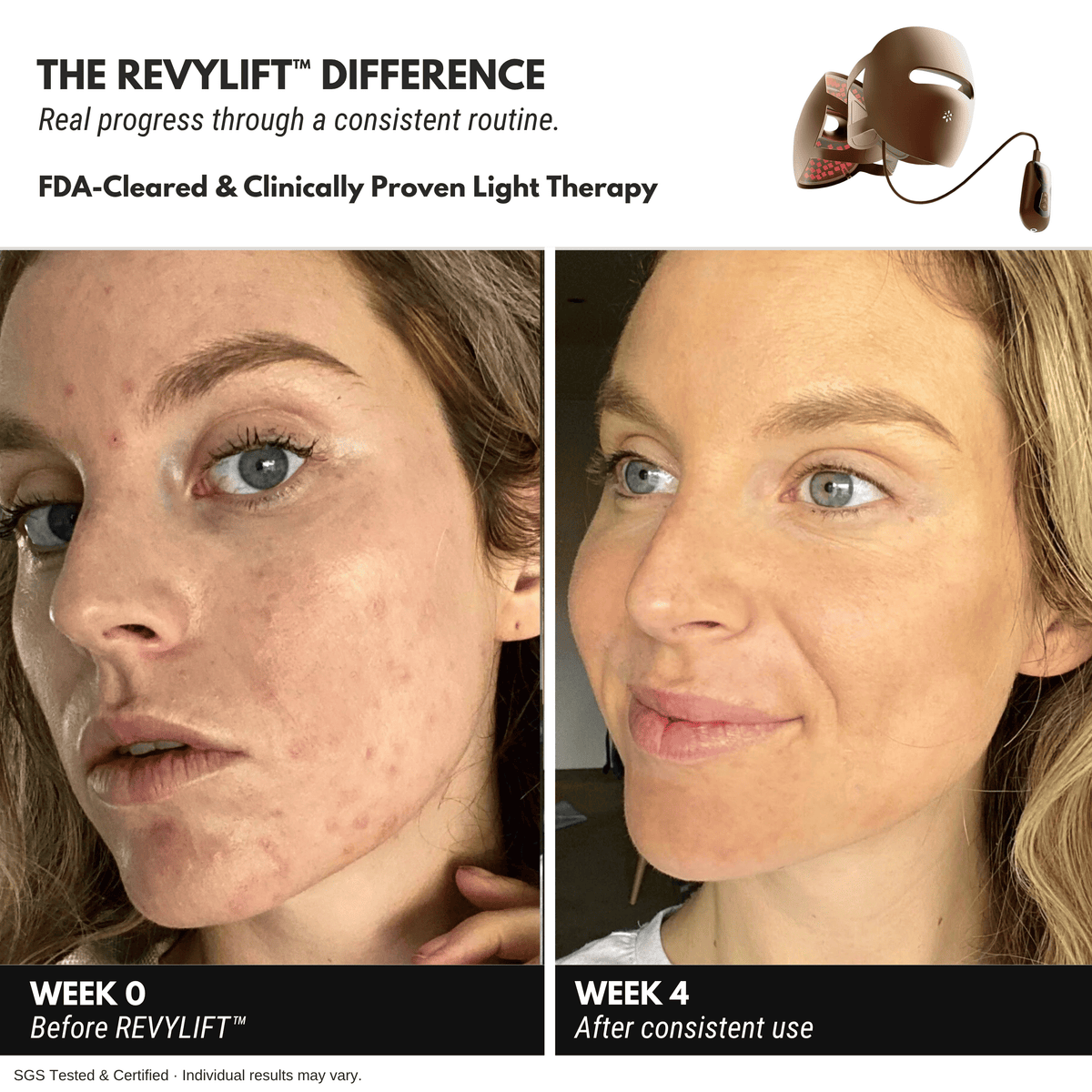 REVYLIFT™ 9D Precision Laser Mask - REVYLIFT